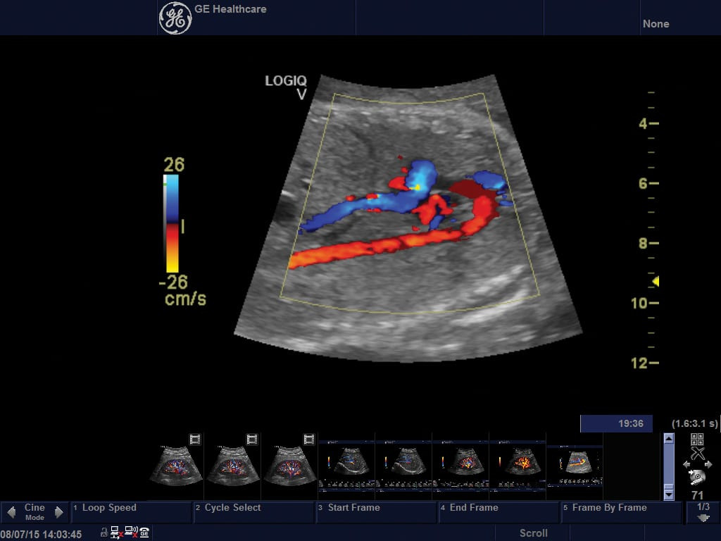 Hình minh họa Doppler màu trên máy LOGIQ V2